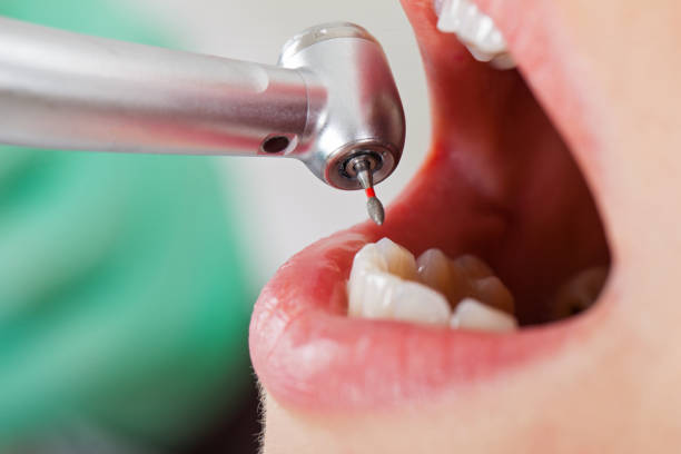 Best Emergency Dentist for Lost Fillings or Crowns in Stone Ridge, NY